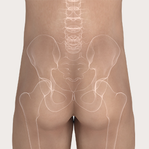 Krok 1 aplikacji Mepilex Border Sacrum